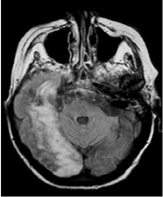 IRM cérébral du patient