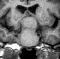 IRM cérébral du patient