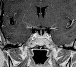 IRM cérébrale d'un témoin