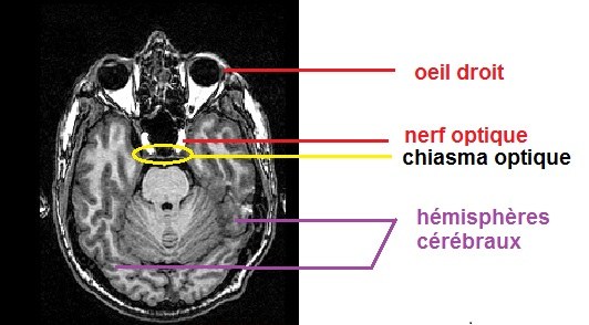IRM chiasma optique, légendé