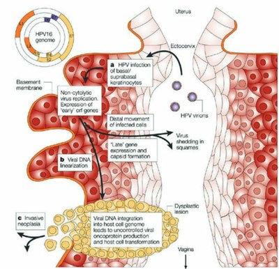 Histoire cancer du col.jpg