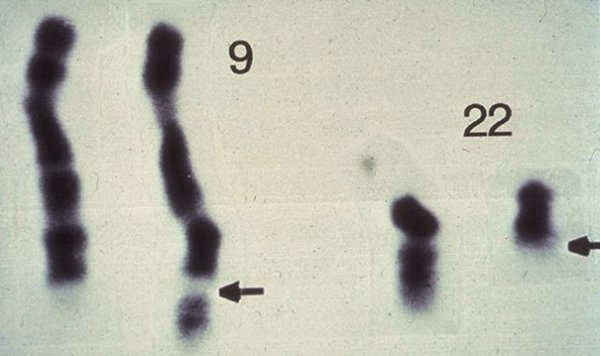 Anomalie chromosomique 9 et 22.jpg