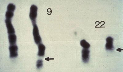 anomalie-chromosomique-9-et-22.jpg