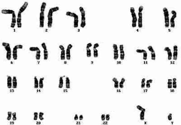 Caryotype cellule normale du même patient.jpg