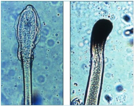 Test du bulbe pileux