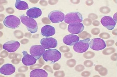 Frottis de moelle osseuse en cas de LAL