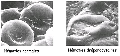 Hématies normales et drépanocytaires