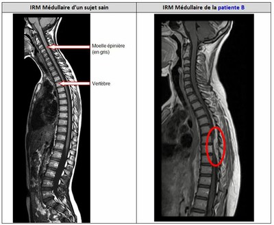 Comparaison IRM medullaire patient sain et B.JPG — Site des ...