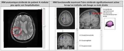 Comparaison lesion patient A motricite main droite sujet sain.JPG