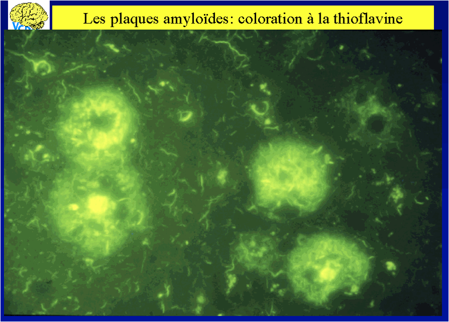 plaques amyloïdes coloration à la thioflavine