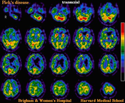 images médicales maladie de Pick