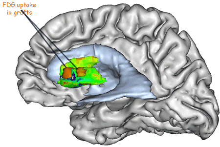 3DTEPstriatumR.gif