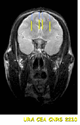 Implanto2CapsuleR.gif