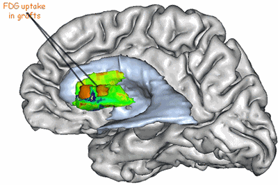 3DTEPstriatumR.gif