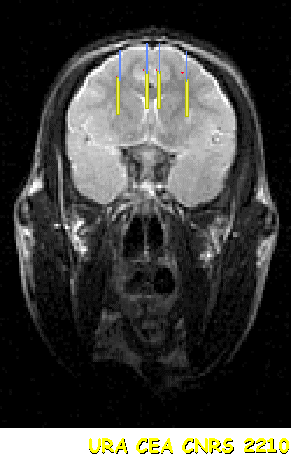 Implanto2CapsuleR.gif