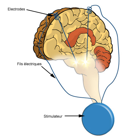 Schéma d&rsquo;une stimulation cérébrale profonde