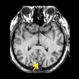 067parieto occipital.png