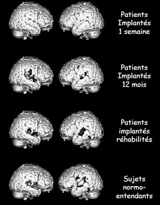réponses corticales à la parole après implant