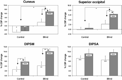 activation cuneus.gif