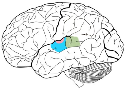 Localisation de l'aire auditive primaire (rose), de l'aire auditive secondaire (bleu) et de l'aire de Wernicke (vert)