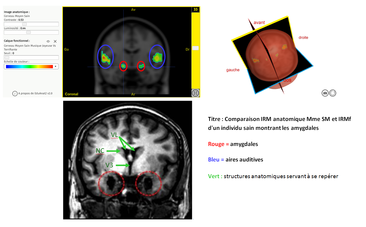 STRESS COMPARAISON sm AMYGDALE