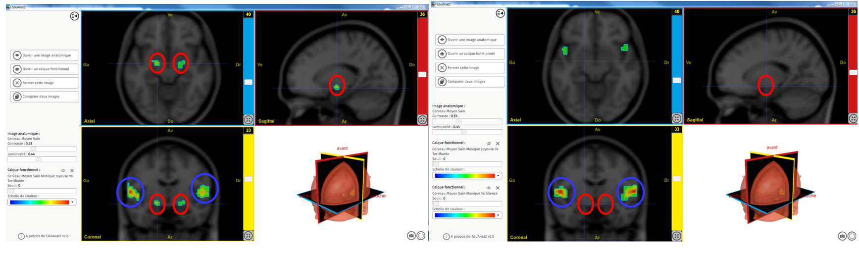 STRESS Eliminer aire auditive
