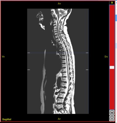 12132MoelleEpiniereSaineComplete T2