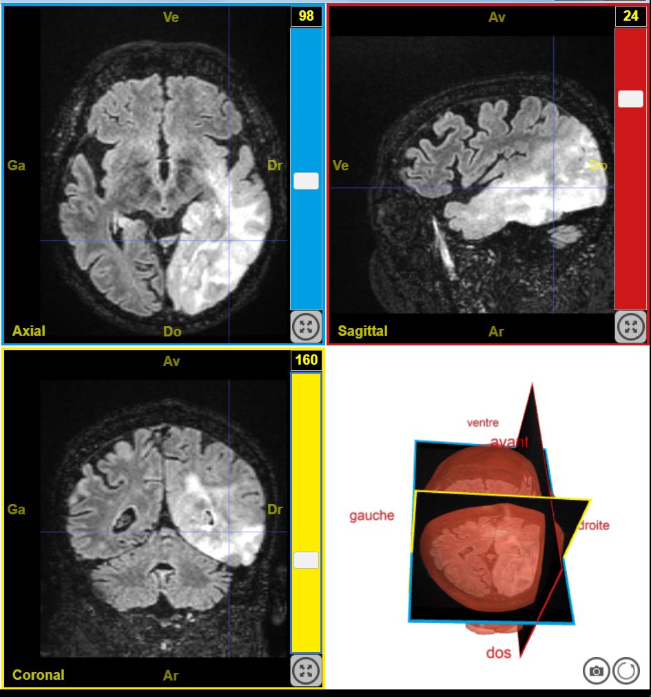 12224PathologieTumeurTroubleSensitifGauche T2Flair
