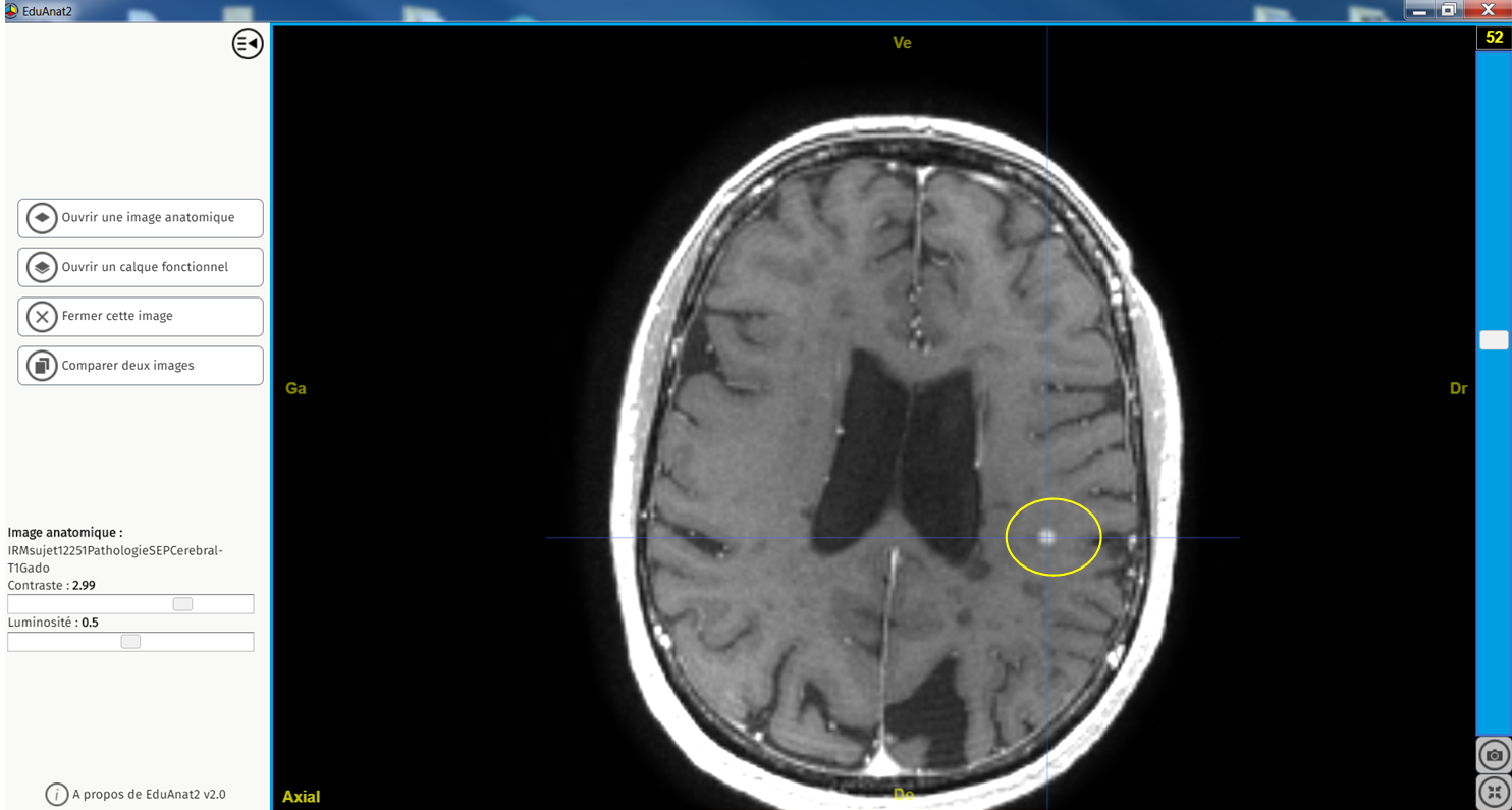 IRM cérébrales et médullaires pathologiques dans le cas d'une ...