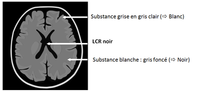Aide lecture IRM T2 FLAIR