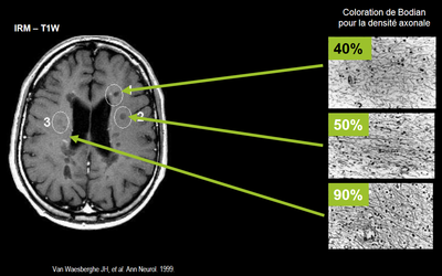 Aspect IRM des lésions de SEP