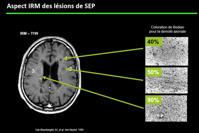 Aspect lesion IRM et densité neurone