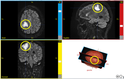 Capture Deficit moteur T2FLAIR