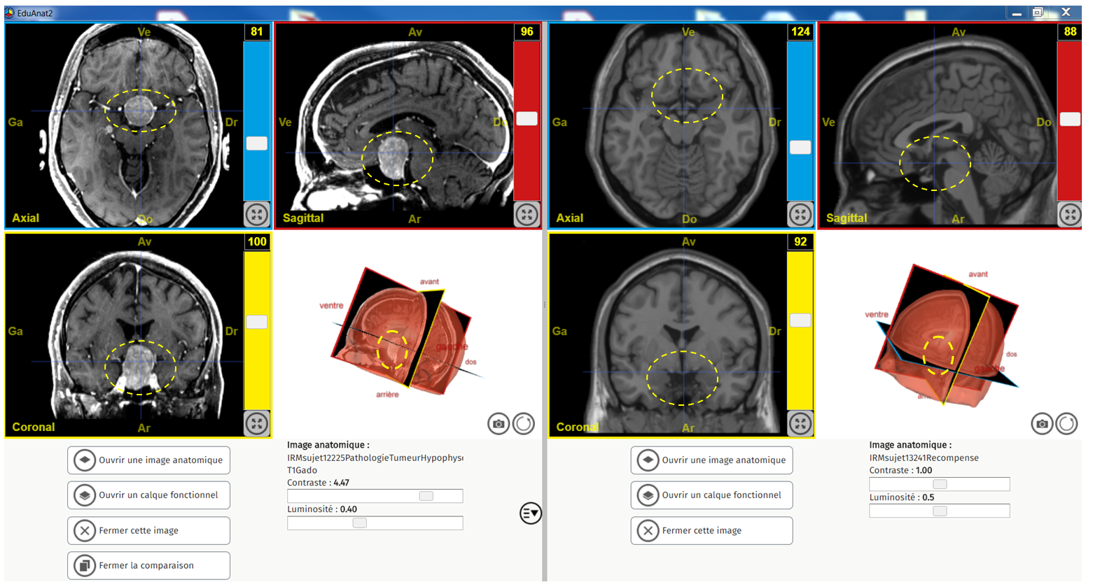 Comparaison sain Tumeur hypophyse