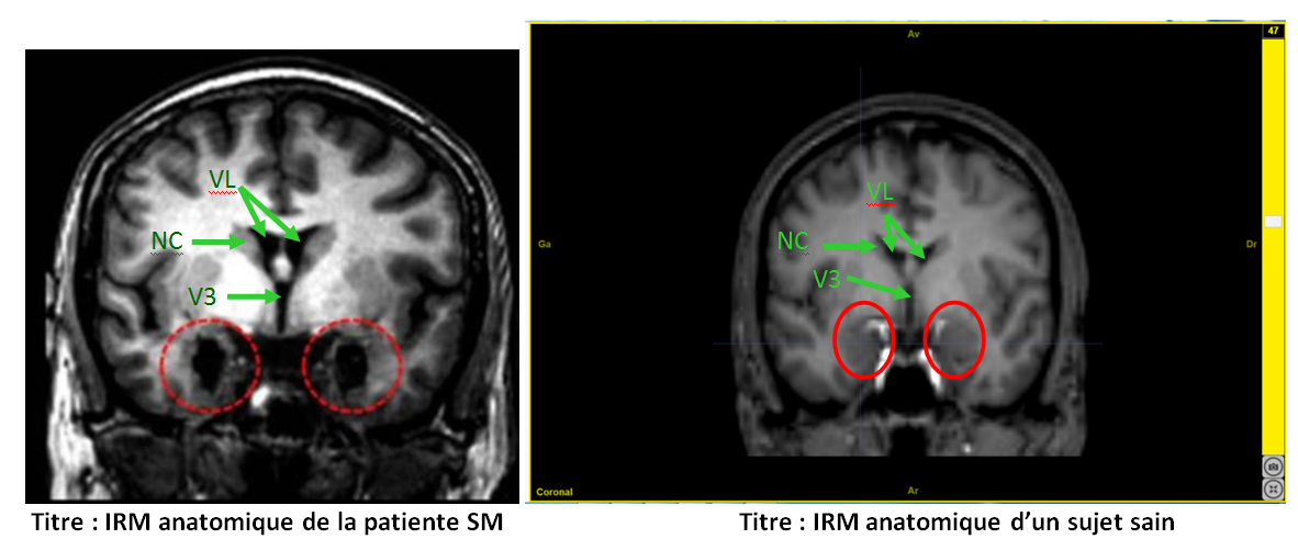 Comparaison SM et sain lésion amygdale