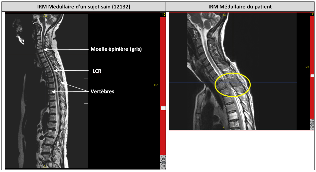 Comparaison tumeur T2T3 et moelle saine