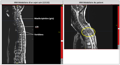 Comparaison tumeur T2T3 et moelle saine