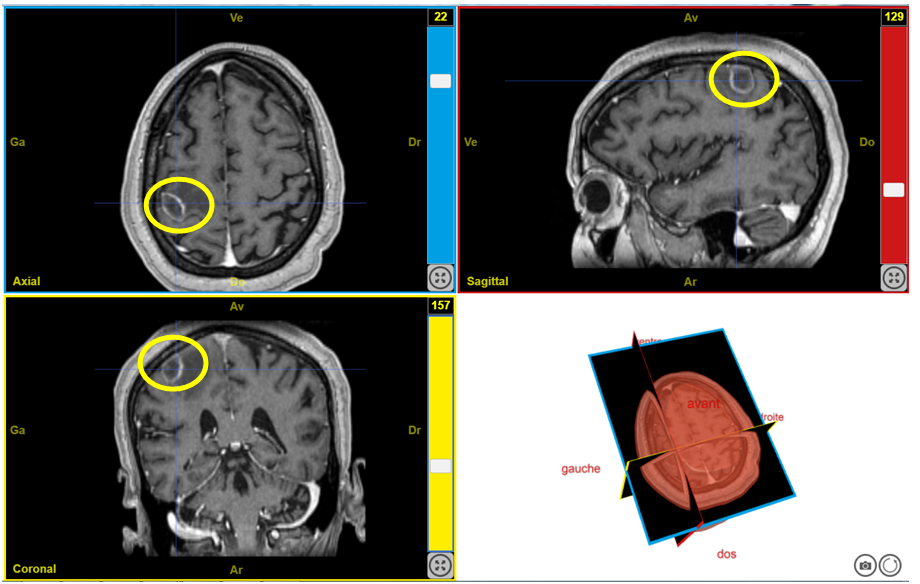 IRM cérébrale pathologique responsable d'un déficit moteur — Site ...