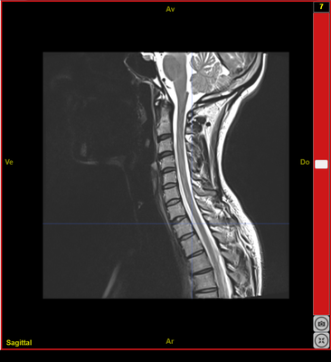 IRMsujet12131MoelleEpiniereSaineC1T5 T2