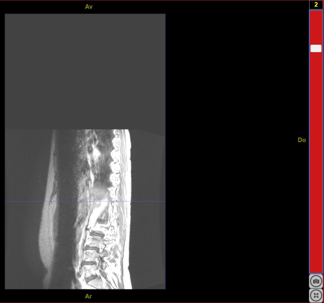 IRMsujet12132MoelleEpiniereSaineComplete T1Gado 