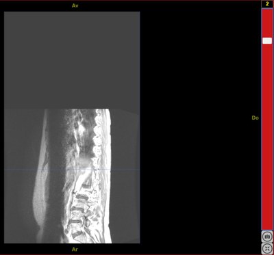 IRMsujet12132MoelleEpiniereSaineComplete T1Gado 