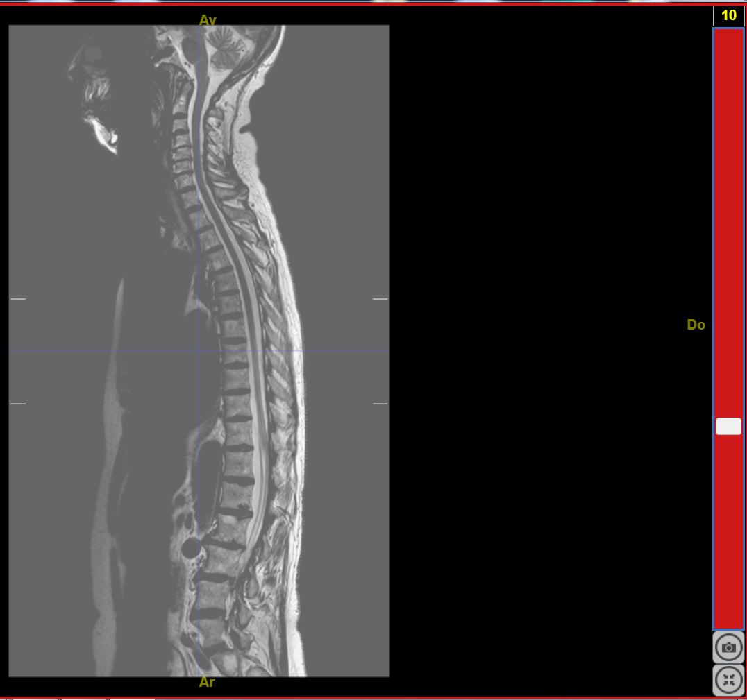 IRMsujet12132MoelleEpiniereSaineComplete T2 