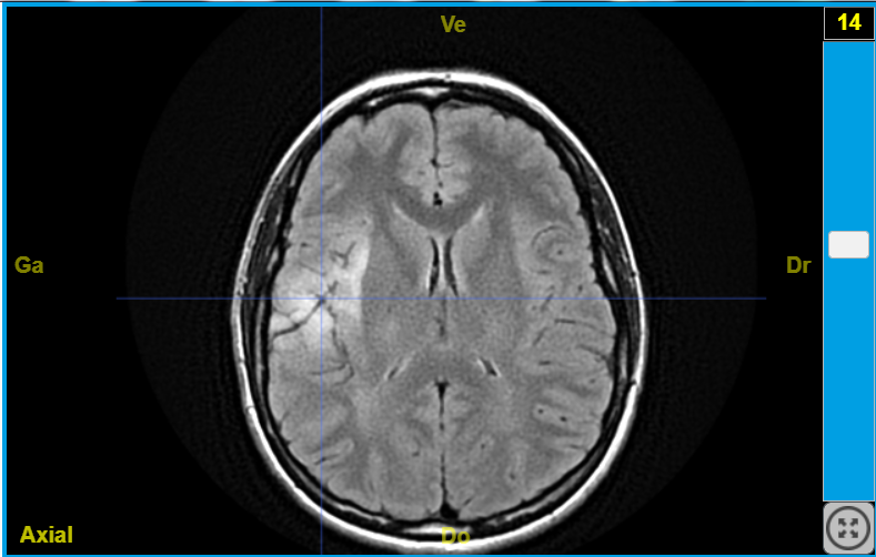 IRMsujet12222PathologieTumeurAudition T2Flair  LCR NOIR
