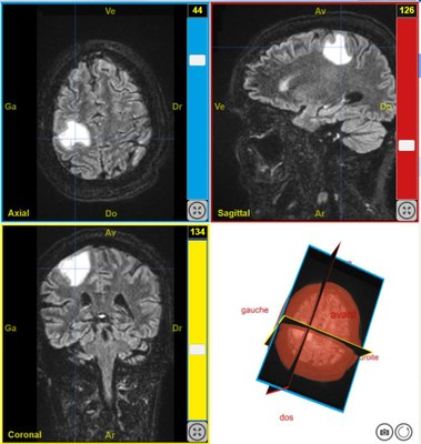 IRMsujet12222PathologieTumeurAudition T2Flair