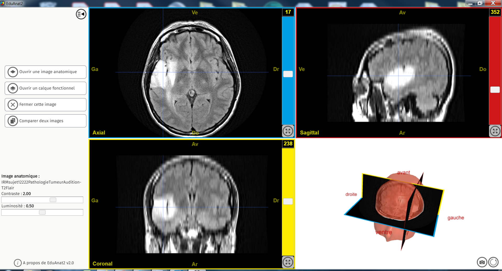IRMsujet12222PathologieTumeurAudition T2Flair