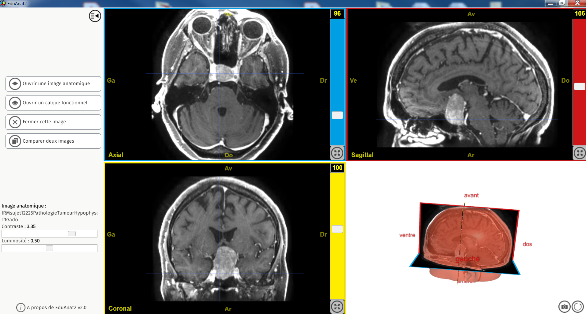 IRMsujet12225PathologieTumeurHypophyse T1Gado