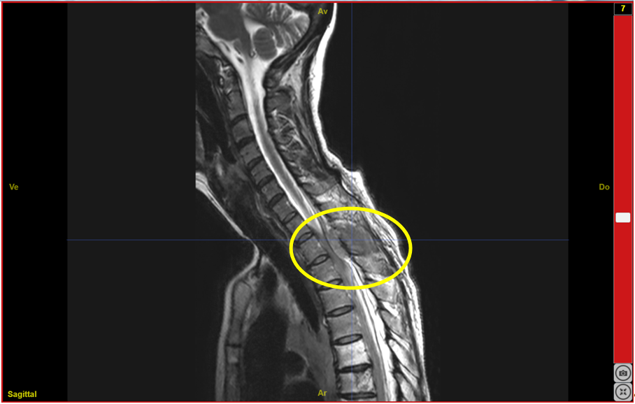 IRMsujet122421PathologieMedullaireCompressionT2T3.anat.nii.gz