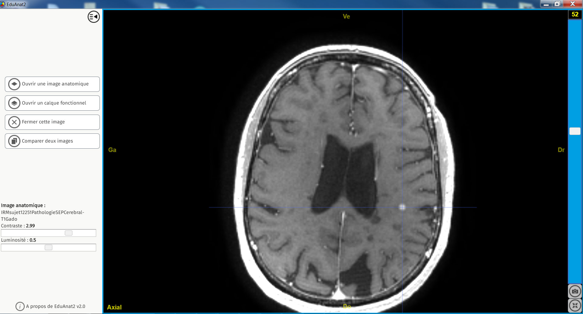 IRMsujet12251PathologieSEPCerebral FLAIR