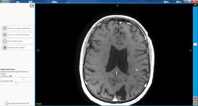 IRMsujet12251PathologieSEPCerebral FLAIR