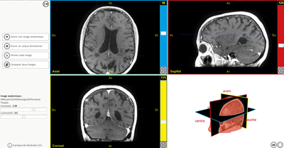 IRMsujet12251PathologieSEPCerebral T1Gado